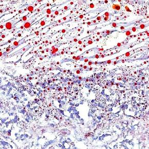 Brain Cancer: how cholesterol overflows glioblastoma stem-like cells